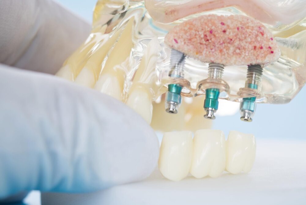 Dantų implantai Kaune