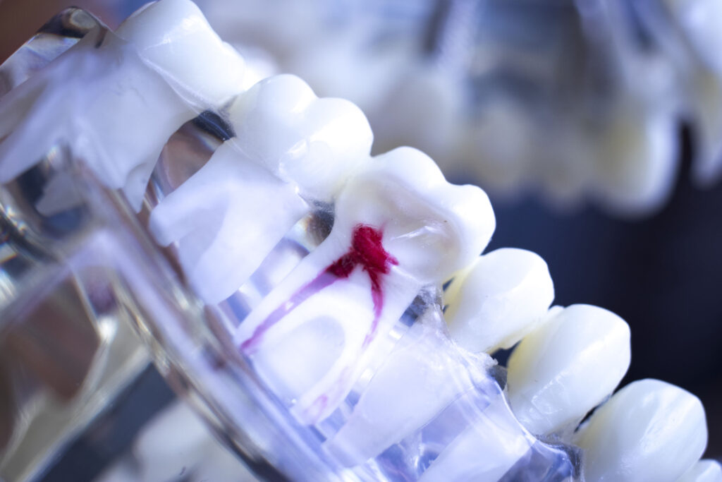 Endodontinis saknu kanalu gydymas